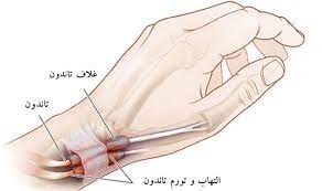 التهاب غلاف تاندون (تنوسینوویت)